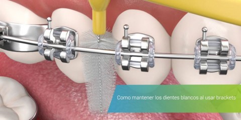 como-mantener-los-dientes-blancos-al-usar-brackets